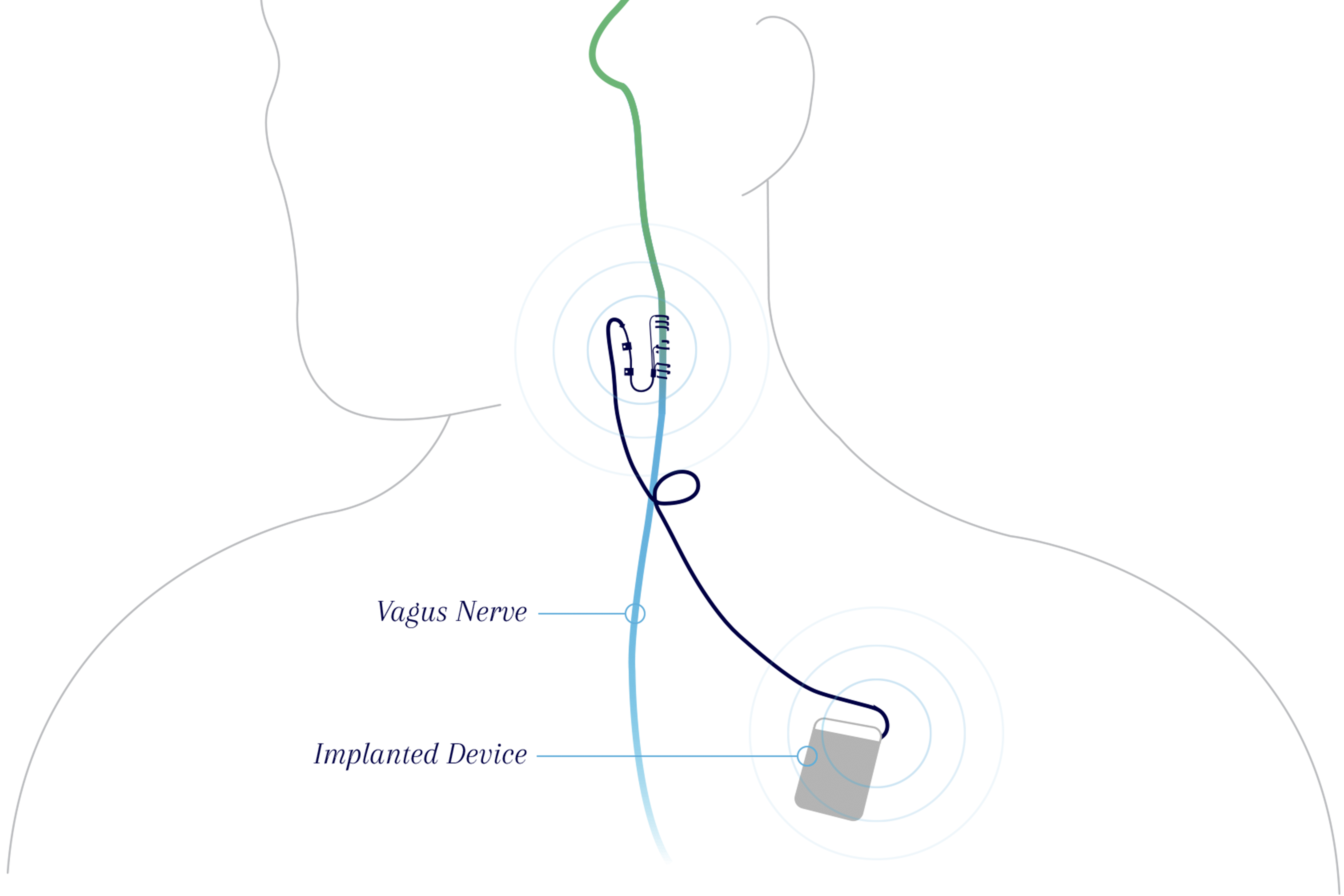 implant-illustration