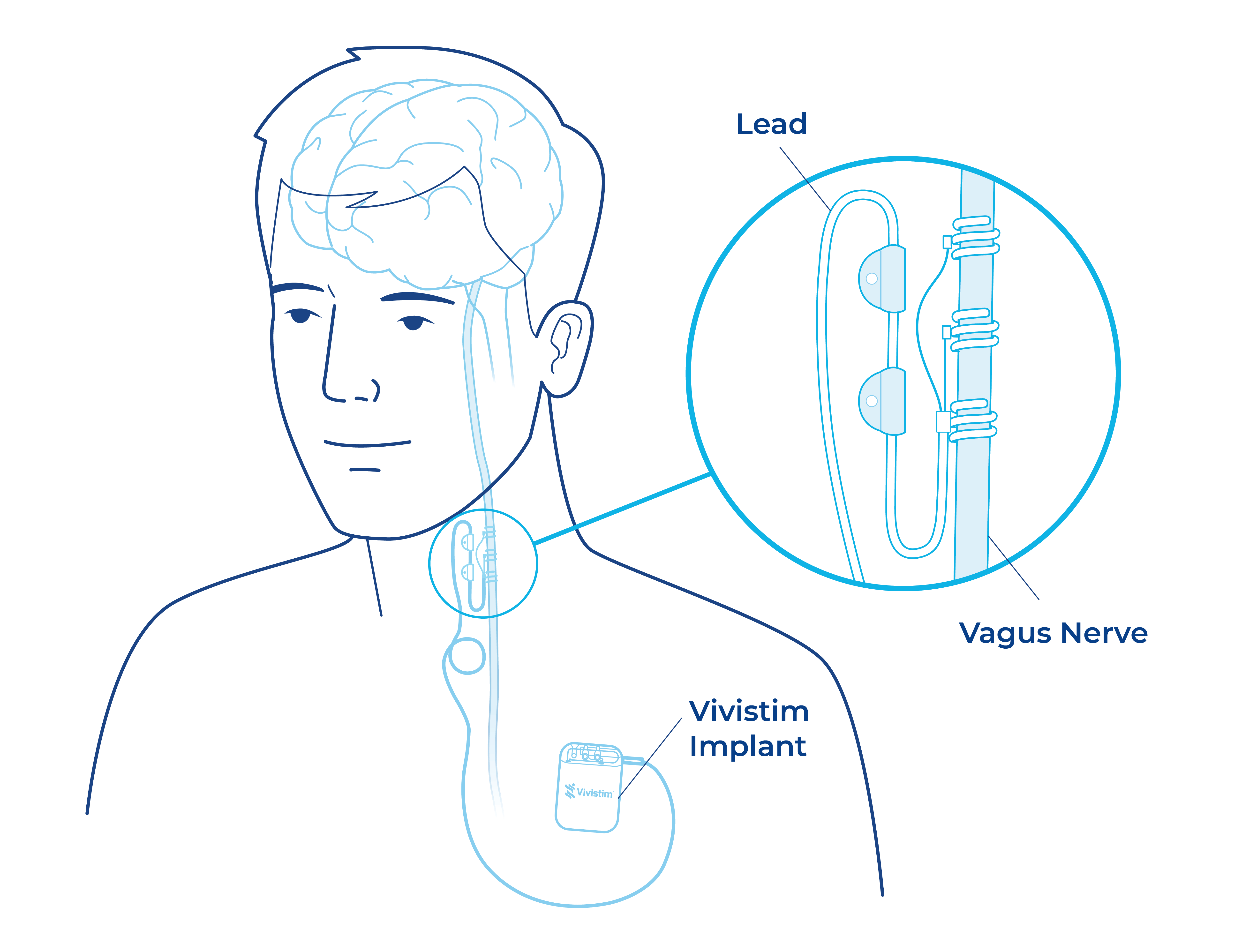 Vivistim Paired VNS System Implant Diagram-Callout+Labels