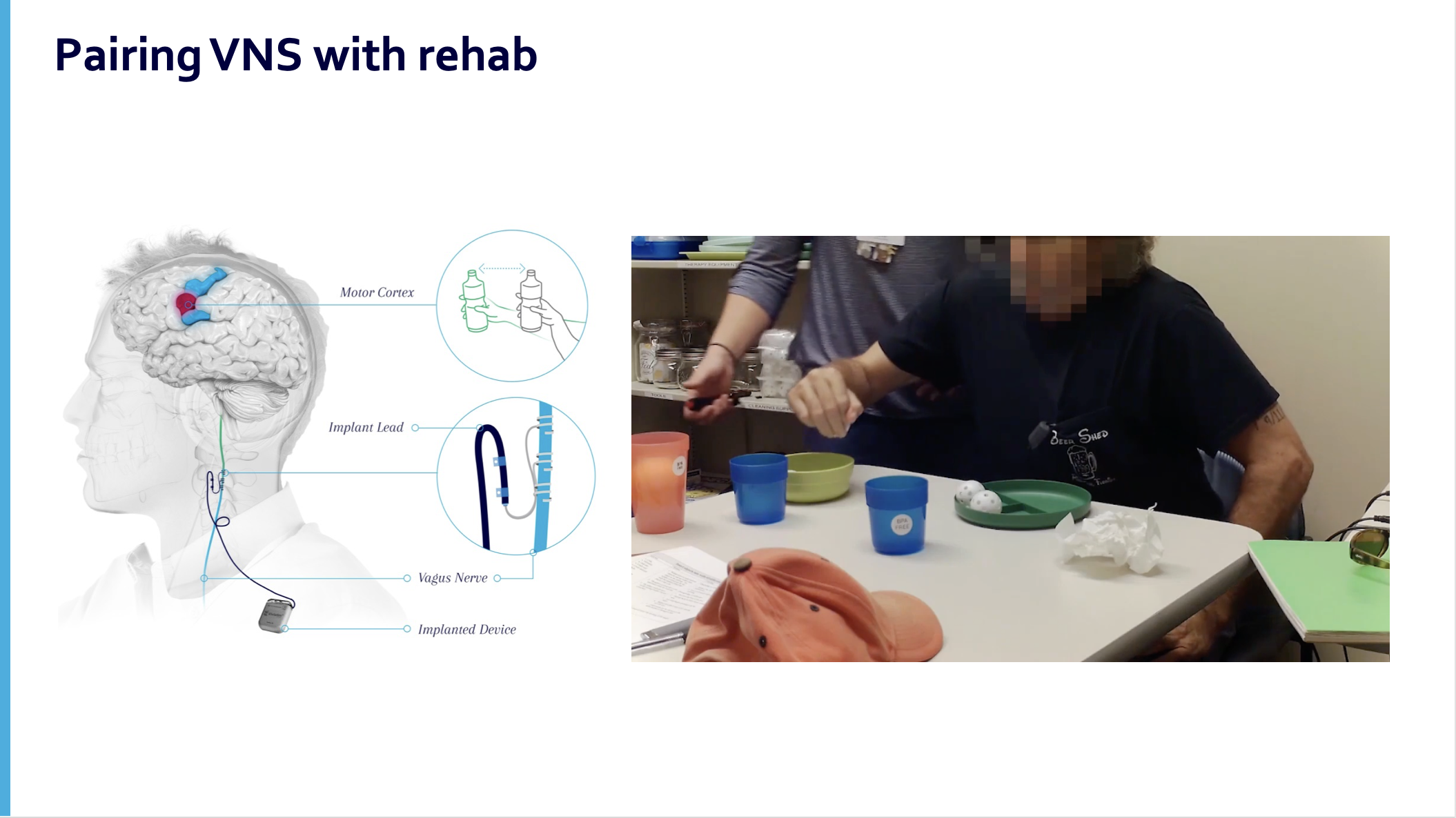 Implementing Paired VNS with Rehab to Improve Motor Function for ...