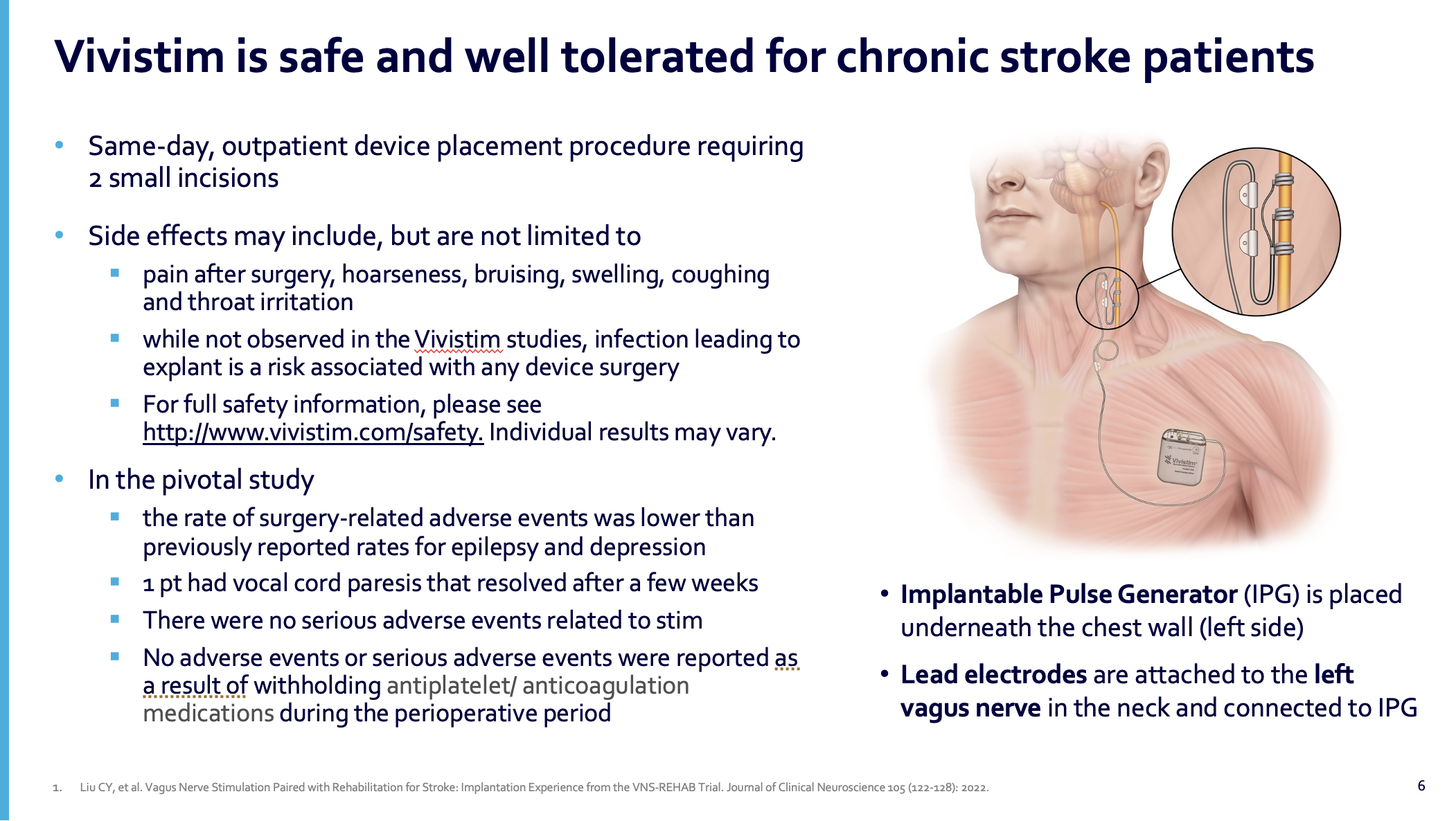 Vivistim Incision Implementing Paired VNS to Improve Motor Function for Chronic Stroke ...