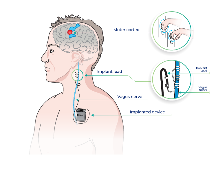 Illustration showing Vivistim Paired VNS™ System implanted in the chest with a lead to the vagus nerve and motor cortex to support post-stroke rehabilitation.